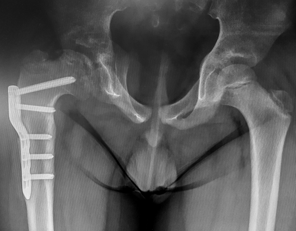 periacetabular osteotomy hip surgery.png