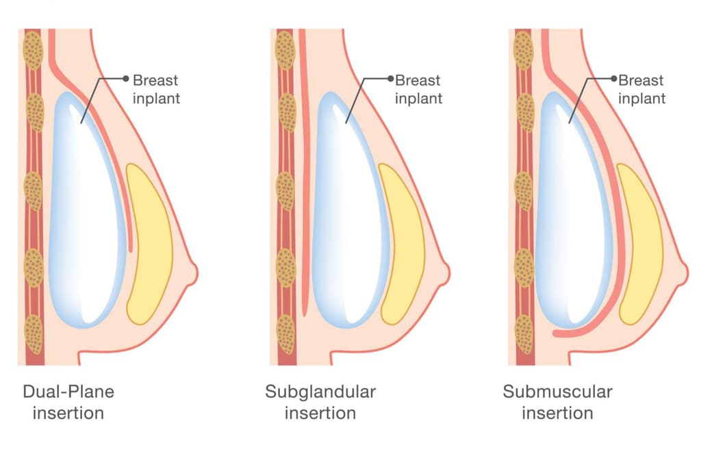 breast-implant.jpg