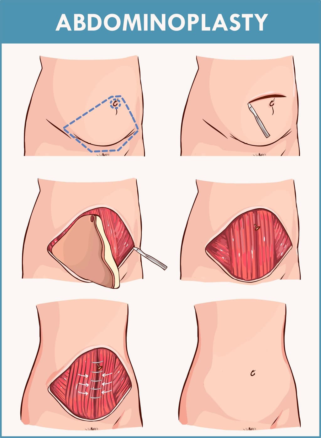 tummy tuck