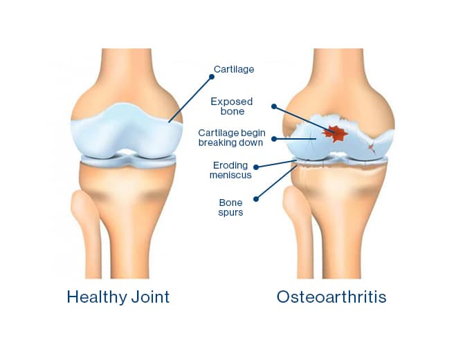 23-10-09_KneeOsteoarthritis