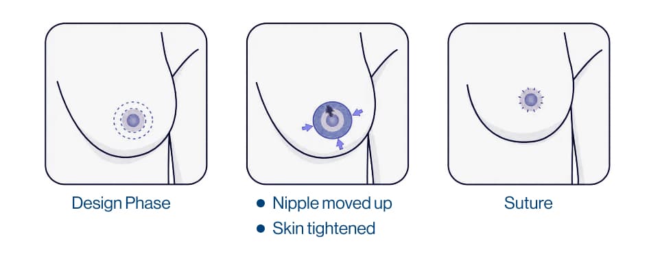 Areola reduction_illustration