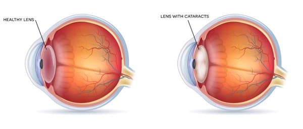 Cataract diagram