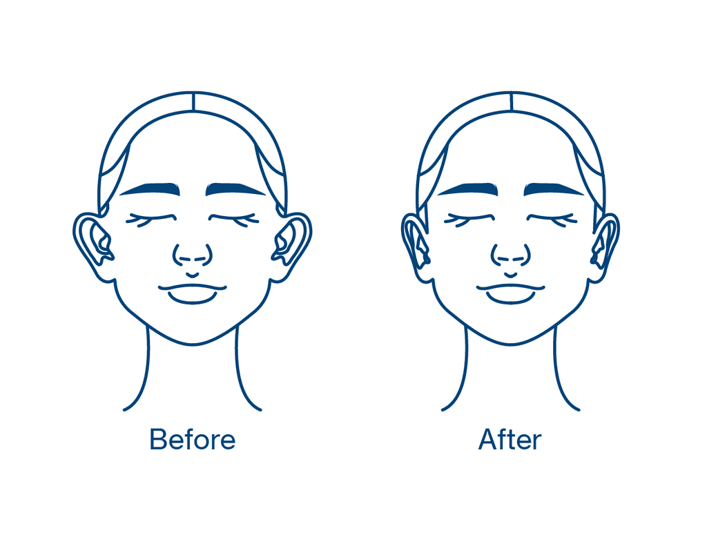 Ear pinning before and after diagram