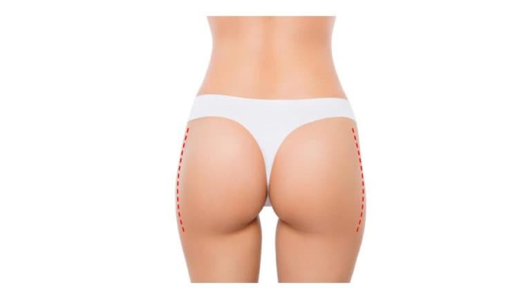 Lateral-Buttock-Lift_Incision-768x432.jpg