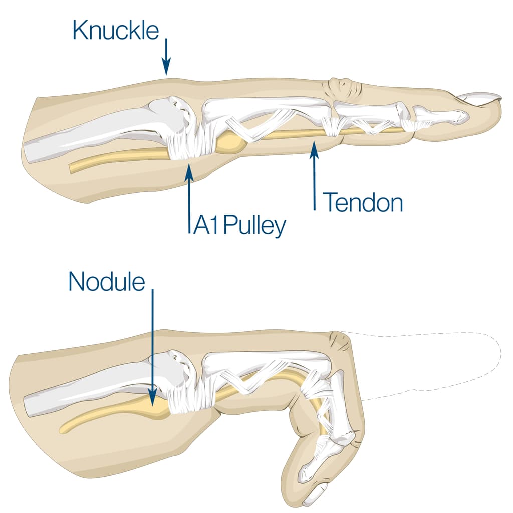 Trigger Finger illustration.jpg