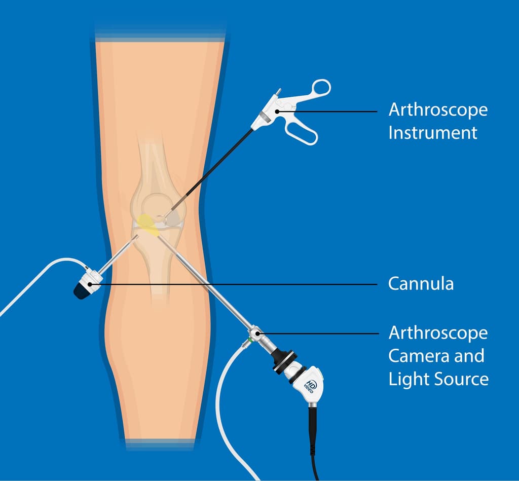 acl_surgical_reconstruction_technique.jpg