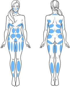 areas for liposuction