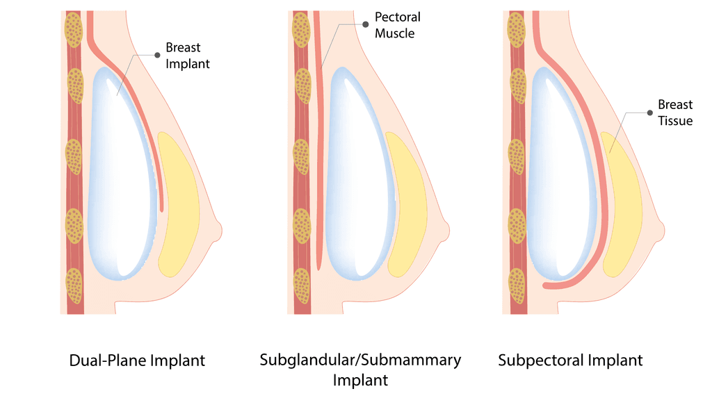 breast implant insertion