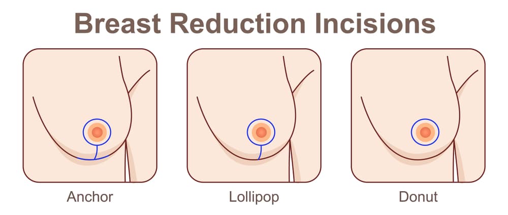 breast_reduction_incision.jpg