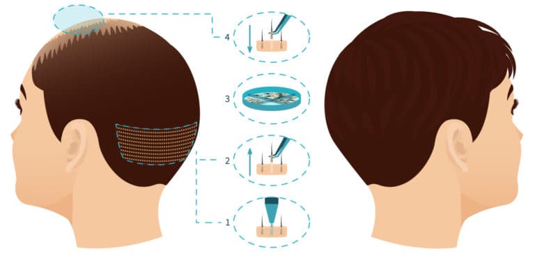 follicular-extraction.jpg