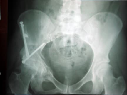 hip_osteotomy_after_1_year.jpg