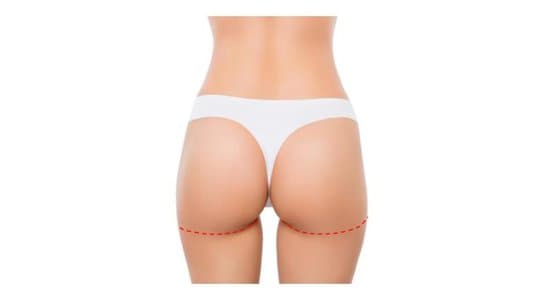 lower buttock lift incision