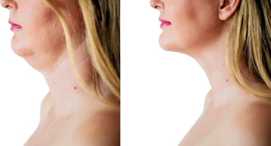 neck lift before and after