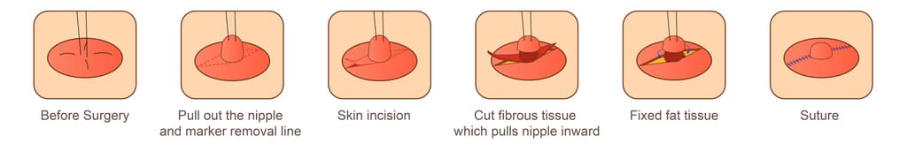 nipple correction surgery