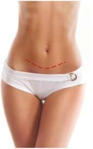 mini (modified) abdominoplasty incision