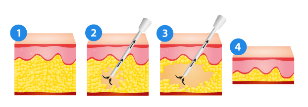 Dry liposuction procedure