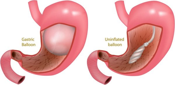 gastric balloon before and after