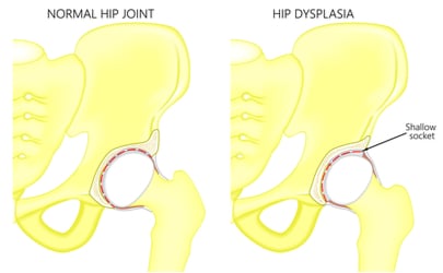 hip dysplasia diagram.jpg