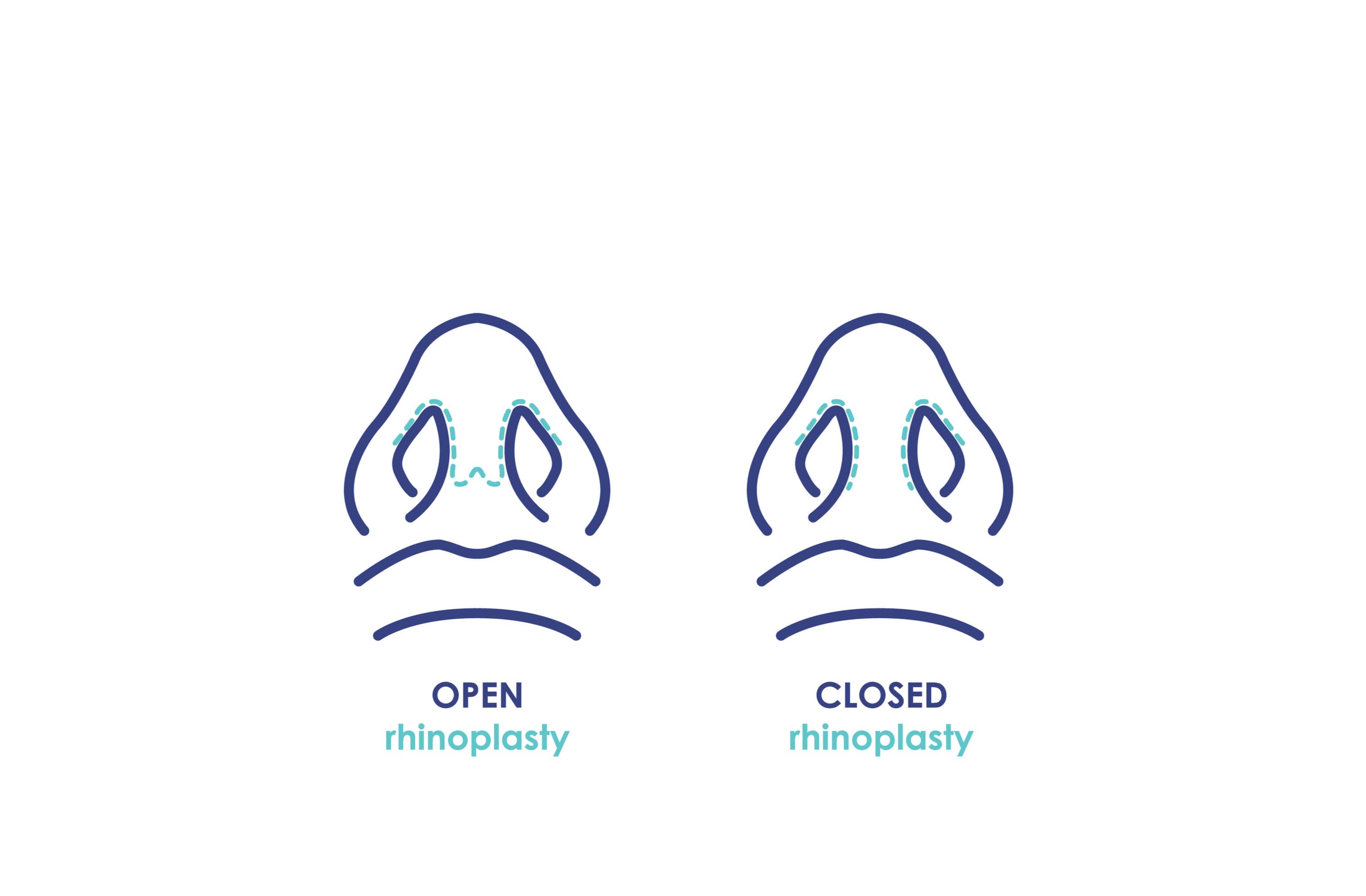 Open and closed Rhinoplasty