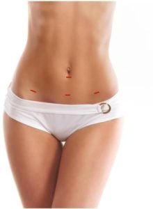 endoscopic abdominoplasty incisions